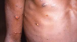 Monkeypox cases detected in Spain