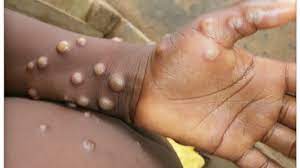 UK health authorities announce two additional monkeypox cases